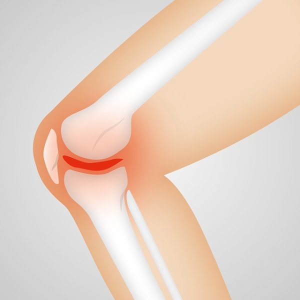 Lutter contre l’arthrose : les traitements et conseils a suivre